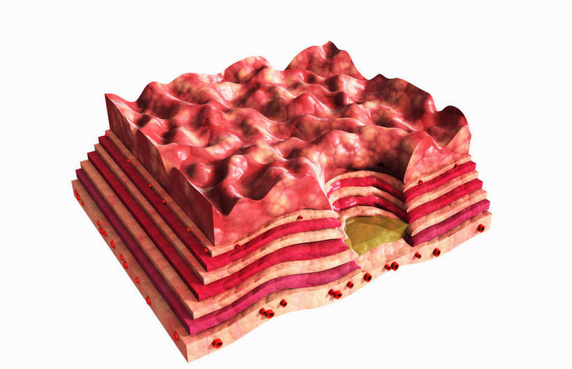 腹部,内脏,胃,动脉,静脉,无人,横图,插画,室内,白天,白色背景,正面,数码,科技,静物,阴影,网络,医学,高光,几何,计算机图形,合成,图画,画,红色,模型,人体,电脑合成图,数码合成图,疾病,生物学,人体器官,器官,漫画,生理学,写实,具体,具象,溃疡,胃部,彩图