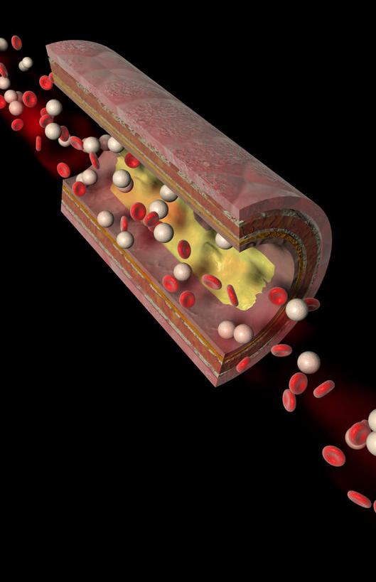 动脉,无人,竖图,插画,室内,特写,白天,正面,数码,科技,阴影,黑色背景,网络,医学,高光,几何,计算机图形,合成,图画,画,血液,电脑合成图,数码合成图,疾病,生物学,漫画,生理学,写实,具体,具象,动脉硬化,动脉粥样硬化,血块,动脉管壁,彩图,血管壁