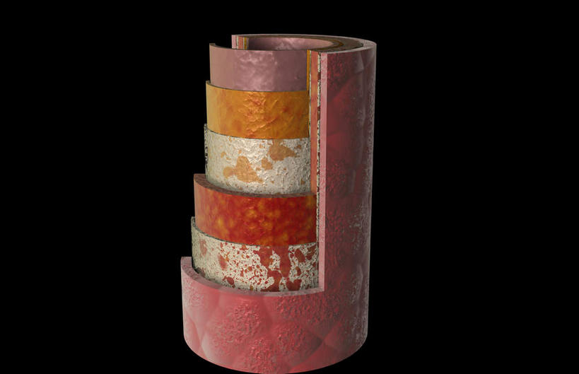 动脉,无人,横图,插画,室内,特写,白天,正面,数码,科技,阴影,黑色背景,网络,医学,高光,几何,计算机图形,合成,图画,画,血液,电脑合成图,数码合成图,疾病,生物学,漫画,生理学,写实,具体,具象,动脉硬化,动脉粥样硬化,血块,动脉管壁,静脉瓣膜,静脉壁,彩图,血管壁