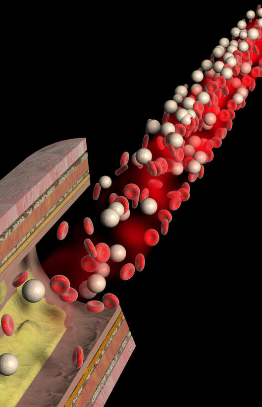 动脉,无人,竖图,插画,室内,特写,白天,正面,数码,科技,阴影,黑色背景,网络,医学,高光,几何,计算机图形,合成,图画,画,血液,电脑合成图,数码合成图,疾病,生物学,漫画,生理学,写实,具体,具象,动脉硬化,动脉粥样硬化,血块,动脉管壁,彩图,血管壁