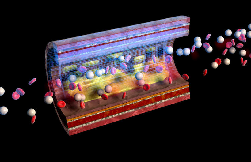 动脉,无人,横图,插画,室内,特写,白天,正面,数码,科技,阴影,黑色背景,网络,医学,高光,几何,计算机图形,合成,图画,画,血液,电脑合成图,数码合成图,疾病,生物学,漫画,生理学,写实,具体,具象,动脉硬化,动脉粥样硬化,血块,动脉管壁,彩图,血管壁