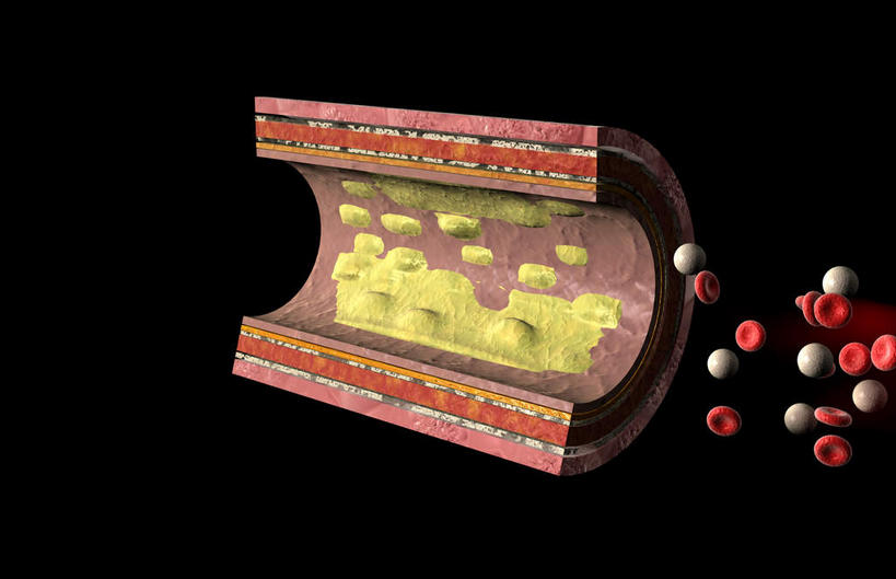 血管,无人,横图,插画,室内,白天,正面,数码,科技,静物,阴影,黑色背景,网络,红血球,医学,高光,几何,计算机图形,合成,图画,画,人体,电脑合成图,数码合成图,疾病,生物学,漫画,生理学,写实,具体,具象,动脉粥样硬化,白血球,彩图,血管壁