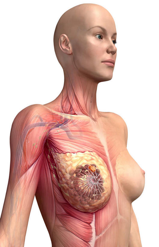 胸,无人,竖图,插画,室内,特写,白天,白色背景,正面,数码,科技,静物,阴影,网络,医学,高光,几何,计算机图形,合成,图画,画,人体,电脑合成图,数码合成图,生物学,肿瘤,乳腺癌,漫画,癌症,生理学,写实,具体,具象,肿瘤细胞,女性,胸部,彩图