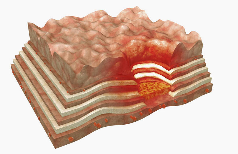 无人,横图,插画,室内,特写,白天,白色背景,正面,数码,科技,静物,阴影,网络,医学,高光,几何,计算机图形,合成,图画,画,粘液,人体,电脑合成图,数码合成图,生物学,漫画,生理学,写实,具体,具象,浆膜,消化性溃疡,粘膜下层,慢性胃溃疡,彩图,胃溃疡