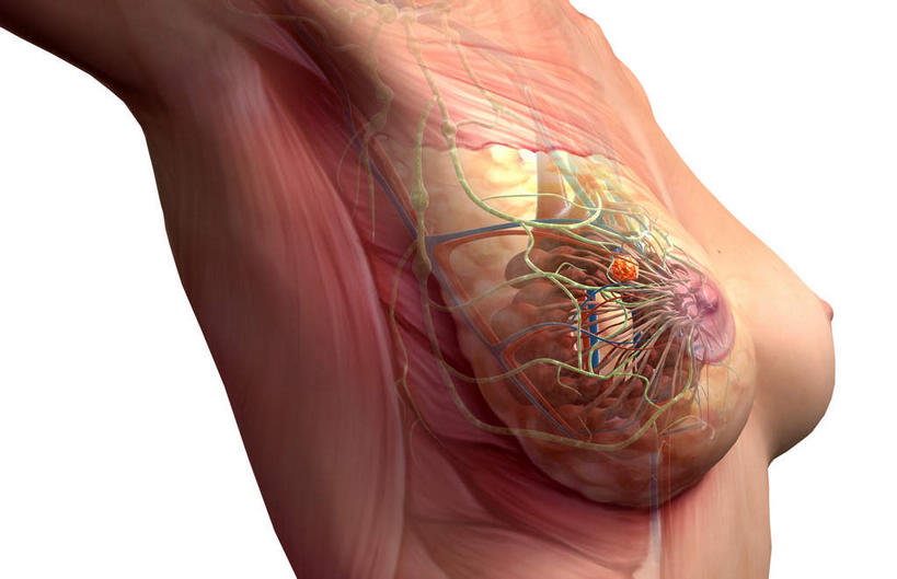 胸,无人,横图,插画,室内,特写,白天,白色背景,正面,数码,科技,静物,阴影,网络,医学,高光,几何,计算机图形,合成,图画,画,人体,电脑合成图,数码合成图,生物学,肿瘤,乳腺癌,漫画,癌症,生理学,写实,具体,具象,肿瘤细胞,女性,胸部,彩图