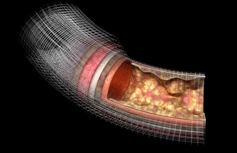 内脏,动脉,静脉,无人,横图,插画,室内,白天,正面,数码,科技,静物,阴影,黑色背景,网络,医学,高光,几何,计算机图形,合成,图画,画,模型,人体,电脑合成图,数码合成图,生物学,人体器官,器官,漫画,生理学,写实,具体,具象,动脉硬化,动脉粥样硬化,血管病,彩图