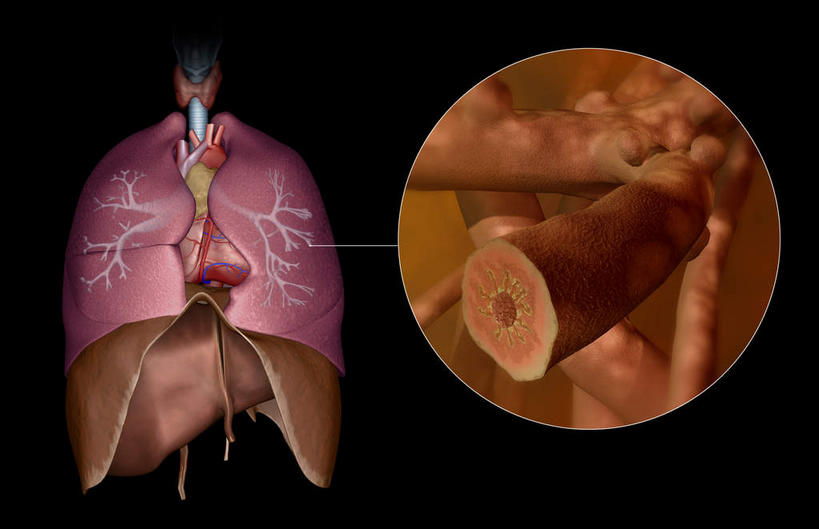 内脏,动脉,静脉,无人,横图,室内,特写,白天,正面,数码,科技,静物,阴影,黑色背景,网络,医学,细胞,高光,几何,计算机图形,合成,模型,人体,电脑合成图,数码合成图,生物学,人体器官,器官,哮喘,过敏,生理学,写实,具体,具象,彩图