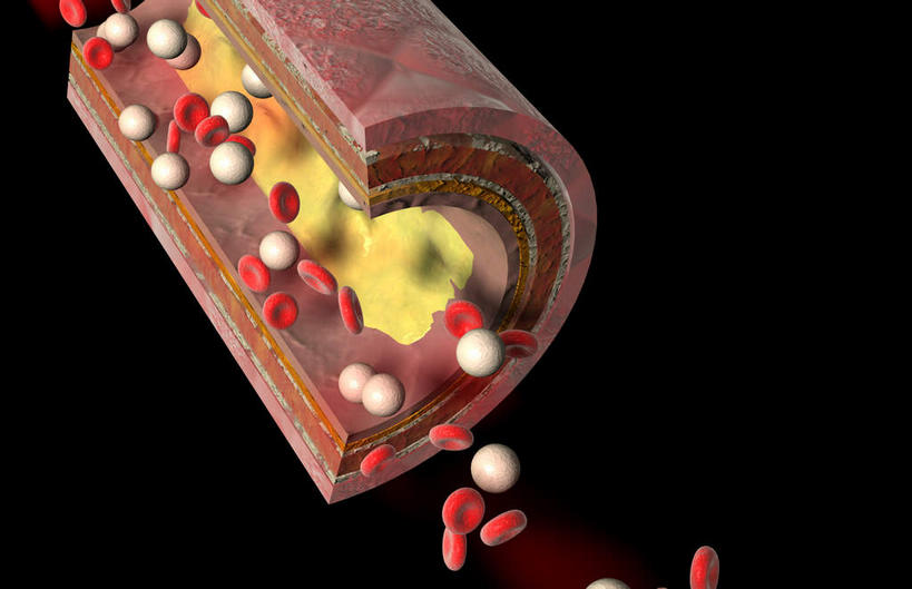 内脏,动脉,静脉,无人,横图,室内,特写,白天,正面,数码,科技,静物,阴影,黑色背景,网络,医学,高光,几何,计算机图形,合成,红色,模型,人体,电脑合成图,数码合成图,生物学,人体器官,器官,生理学,写实,具体,具象,动脉硬化,动脉粥样硬化,血管病,彩图