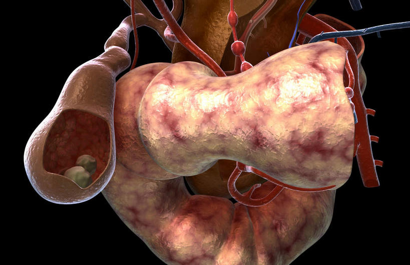 内脏,动脉,静脉,胆囊,无人,横图,插画,室内,特写,白天,正面,数码,科技,石头,静物,阴影,黑色背景,网络,医学,石子,两颗,高光,几何,计算机图形,合成,图画,画,模型,人体,电脑合成图,数码合成图,生物学,人体器官,器官,漫画,生理学,写实,具体,具象,胆,胆结石,结石,石块,彩图