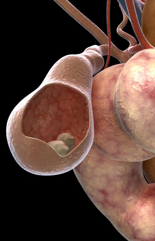 内脏,动脉,静脉,胆囊,无人,竖图,插画,室内,特写,白天,正面,数码,科技,石头,静物,阴影,黑色背景,网络,医学,石子,两颗,高光,几何,计算机图形,合成,图画,画,模型,人体,电脑合成图,数码合成图,生物学,人体器官,器官,漫画,生理学,写实,具体,具象,胆,胆结石,结石,石块,彩图