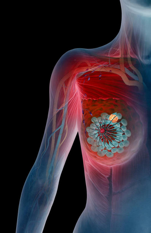 胸,无人,竖图,插画,x光片,室内,特写,白天,正面,数码,科技,静物,阴影,黑色背景,辐射,科学,网络,医学,细胞,高光,几何,计算机图形,合成,图画,画,红色,蓝色,人体,电脑合成图,数码合成图,医疗,生物学,科学技术,x射线,乳腺癌,x光,漫画,癌症,癌细胞,生理学,写实,具体,具象,乳腺,胸部,半身,彩图,电磁波,电磁辐射