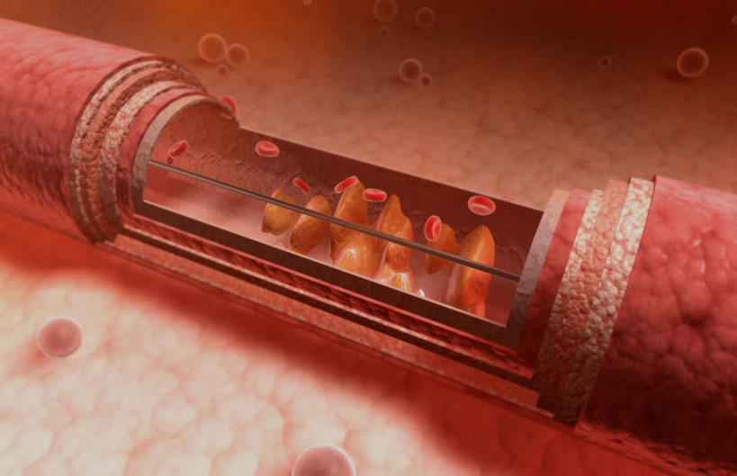 血管,无人,横图,插画,室内,特写,白天,正面,数码,科技,静物,阴影,网络,医学,细胞,高光,几何,计算机图形,合成,图画,画,红色,人体,电脑合成图,数码合成图,生物学,血小板,横截面,漫画,生理学,写实,具体,具象,红细胞,动脉硬化,动脉粥样硬化,彩图