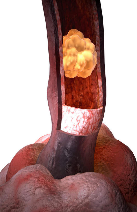 内脏,肺,气管,动脉,静脉,无人,竖图,插画,室内,白天,白色背景,正面,数码,科技,静物,阴影,网络,基因,医学,高光,几何,计算机图形,合成,图画,画,模型,生物,人体,遗传,电脑合成图,数码合成图,疾病,生物学,人体器官,器官,漫画,生理学,写实,具体,具象,肺泡,囊肿性纤维化,遗传信息,遗传因子,遗传学,肺部,肺脏,彩图,消化系统