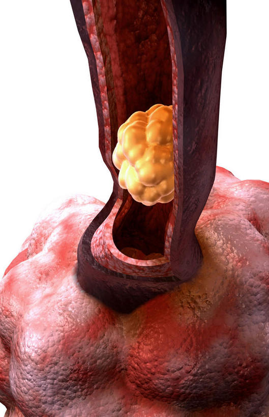 内脏,肺,气管,动脉,静脉,无人,竖图,插画,室内,白天,白色背景,正面,数码,科技,静物,阴影,网络,基因,医学,高光,几何,计算机图形,合成,图画,画,模型,生物,人体,遗传,电脑合成图,数码合成图,疾病,生物学,人体器官,器官,漫画,生理学,写实,具体,具象,肺泡,囊肿性纤维化,遗传信息,遗传因子,遗传学,肺部,肺脏,彩图,消化系统