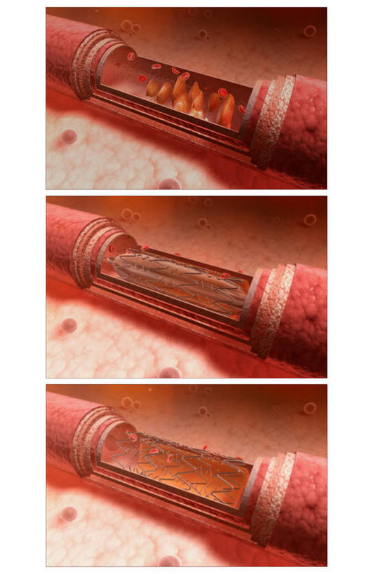 动脉,静脉,无人,竖图,插画,室内,特写,白天,白色背景,正面,数码,科技,静物,阴影,局部,网络,血,医学,高光,几何,计算机图形,合成,图画,画,人体,电脑合成图,数码合成图,生物学,血小板,漫画,生理学,写实,具体,具象,血块,半身,彩图