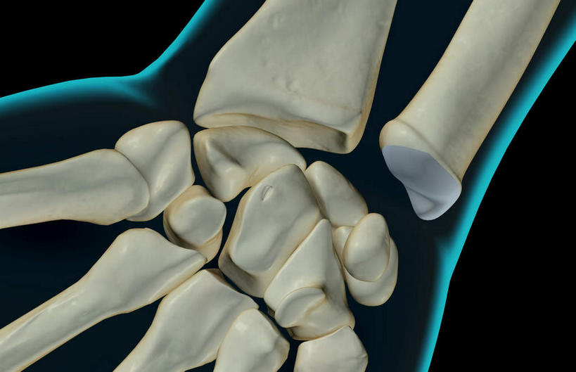 动脉,静脉,骨骼,无人,横图,插画,x光片,室内,特写,白天,正面,数码,科技,静物,阴影,黑色背景,局部,辐射,科学,网络,医学,骨头,高光,几何,计算机图形,合成,图画,画,模型,人体,电脑合成图,数码合成图,骨架,医疗,生物学,科学技术,x射线,x光,漫画,生理学,写实,具体,具象,尺骨,桡骨,腕骨,指骨,手舟骨,钩骨,月骨,半身,彩图,电磁波,电磁辐射