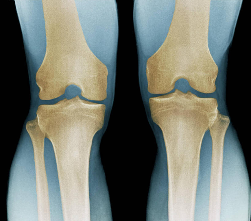 膝盖,骨骼,无人,横图,插画,x光片,室内,白天,正面,数码,科技,阴影,黑色背景,辐射,科学,网络,医学,骨头,高光,几何,计算机图形,合成,图画,画,电脑合成图,数码合成图,骨架,医疗,科学技术,x射线,合成图,x光,漫画,写实,具体,具象,彩图,电磁波,电磁辐射