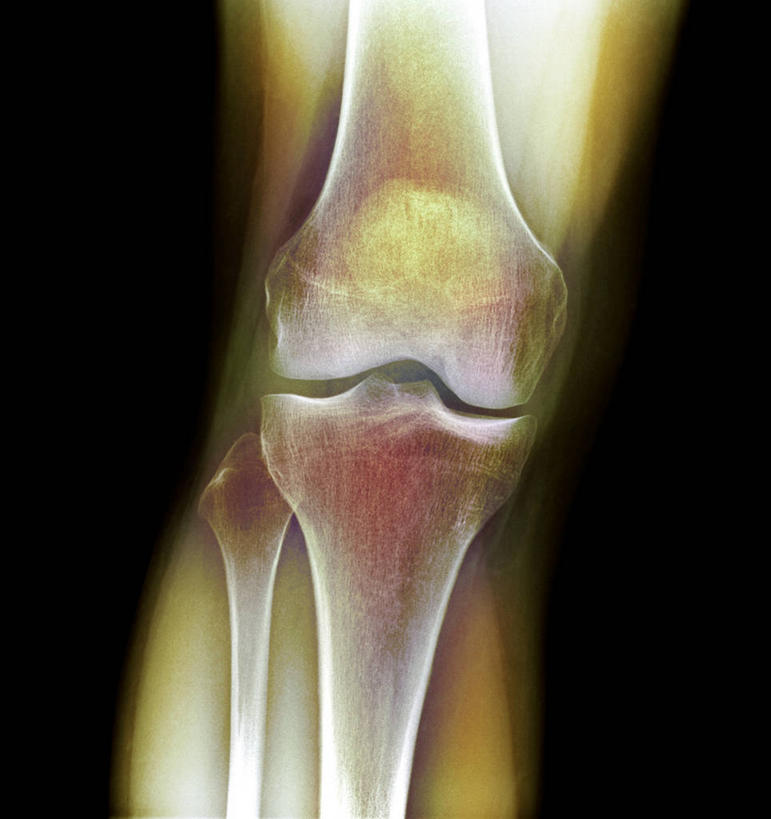 膝盖,骨骼,关节,无人,竖图,插画,x光片,室内,白天,正面,数码,科技,阴影,黑色背景,辐射,科学,网络,医学,骨头,高光,几何,计算机图形,合成,图画,画,电脑合成图,数码合成图,骨架,医疗,科学技术,x射线,合成图,x光,漫画,写实,具体,具象,彩图,电磁波,电磁辐射