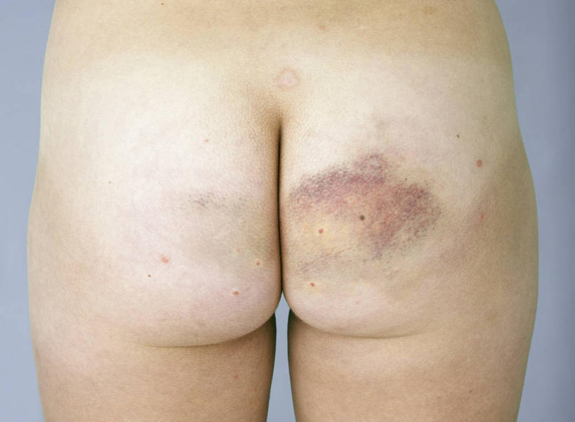 西方人,臀部,一个人,站,横图,室内,特写,白天,欧洲,欧洲人,仅一个年轻女性,仅一个女性,仅一个人,裸露,背面,站着,摄影,影棚,裸,年轻女性,女人,女性,白种人,屁股,站立,半身,彩图,影棚拍摄,拍摄,淤青