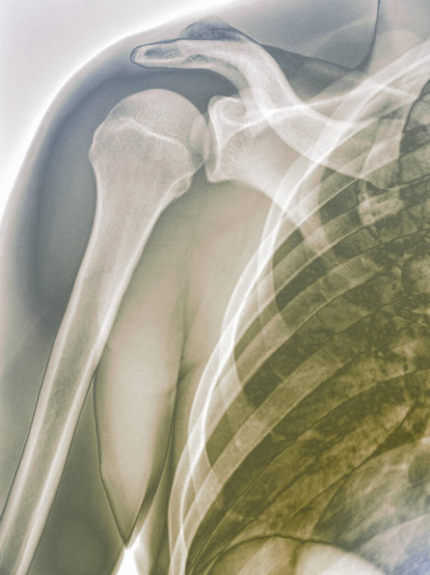 脊髓,骨骼,肌肉,健壮,无人,竖图,x光片,室内,特写,白天,正面,辐射,科学,医学,骨头,肩膀,健康,活力,力量,青春,骨架,医疗,科学技术,x射线,强壮,x光,脊柱,X光图片,X光图像,彩图,电磁波,电磁辐射