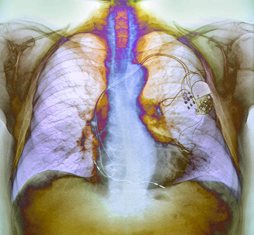 内脏,肺,动脉,静脉,无人,横图,插画,x光片,室内,白天,正面,数码,科技,静物,阴影,辐射,科学,网络,医学,工具,线条,高光,几何,计算机图形,合成,图画,画,模型,人体,轮廓,电脑合成图,数码合成图,医疗,生物学,人体器官,科学技术,x射线,器官,起搏器,医疗器械,x光,心脏起搏器,医疗工具,漫画,癌症,生理学,写实,具体,具象,肺癌,辅助工具,肺部,肺脏,咽喉,彩图,电磁波,电磁辐射