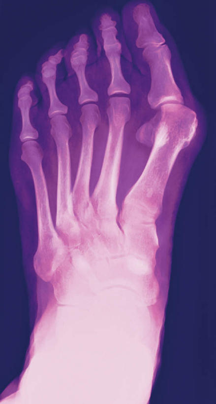 腿部,脚,脚趾,脚趾甲,腿,无人,竖图,x光片,室内,白天,正面,紫色背景,辐射,科学,医学,医疗,科学技术,x射线,x光,脚指甲,彩图,电磁波,电磁辐射