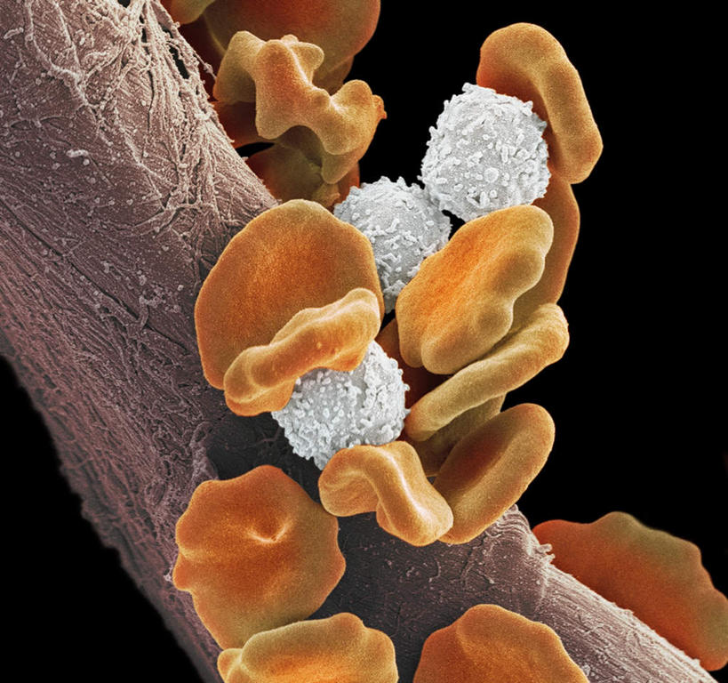 无人,竖图,室内,特写,白天,正面,数码,科技,静物,一堆,阴影,堆叠,堆积,黑色背景,网络,红血球,医学,细胞,高光,几何,计算机图形,合成,黄色,人体,堆,电脑合成图,数码合成图,生物学,血细胞,不幸,癌症,可怜,生理学,写实,具体,具象,红细胞,白血病,血癌,彩图