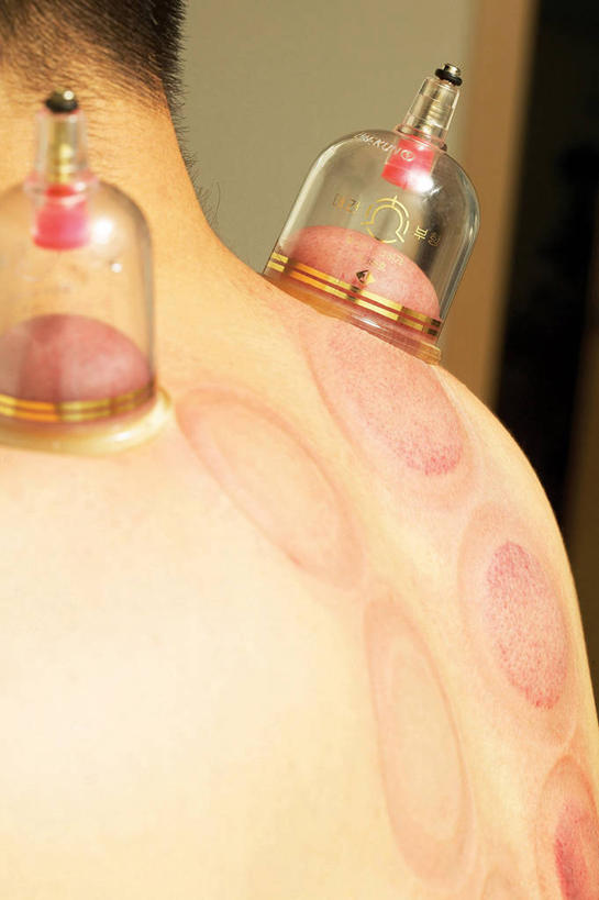 东方人,一个人,竖图,室内,特写,白天,侧面,亚洲,仅一个男性,仅一个人,朦胧,模糊,医学,黄种人,文化,裸露,肩膀,仅一个年轻男性,治疗,保健,医疗,中国文化,裸,拔火罐,中医,火罐,医治,拔罐,拔罐疗法,拔罐子,火罐疗法,中医学,男人,男性,年轻男性,亚洲人,半身,彩图,传统文化