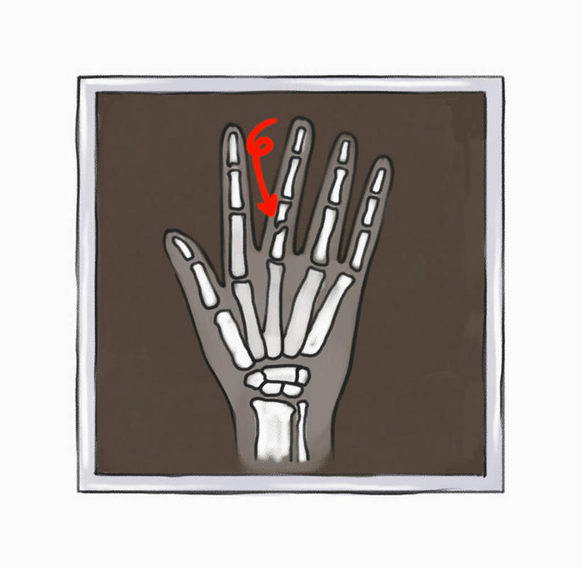 无人,横图,插画,x光片,室内,白天,正面,数码,科技,阴影,辐射,科学,网络,医学,高光,几何,计算机图形,合成,图画,方向,箭头,画,红色,电脑合成图,数码合成图,医疗,科学技术,x射线,指向,合成图,x光,漫画,写实,具体,具象,簇,尺骨,肱骨,桡骨,腕骨,掌骨,指骨,彩图,电磁波,电磁辐射