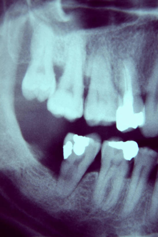 牙齿,无人,竖图,x光片,室内,特写,白天,正面,静物,辐射,科学,医学,医疗,科学技术,x射线,假牙,x光,活动假牙,义齿,齿,牙,牙龈,彩图,电磁波,电磁辐射