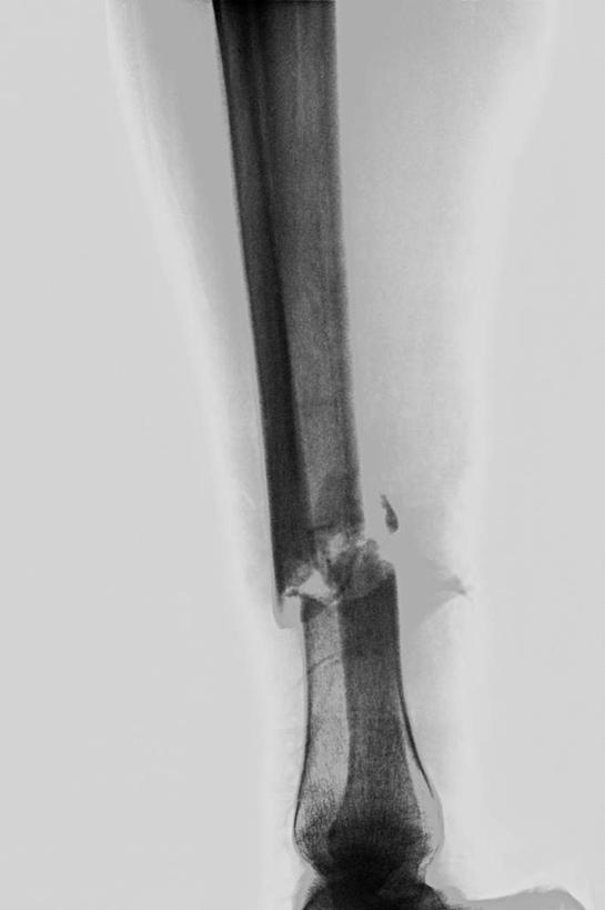 骨骼,无人,竖图,x光片,室内,特写,白天,白色背景,正面,静物,辐射,科学,医学,骨头,骨架,医疗,科学技术,x射线,x光,髌骨,腓骨,股骨,胫骨,彩图,电磁波,电磁辐射