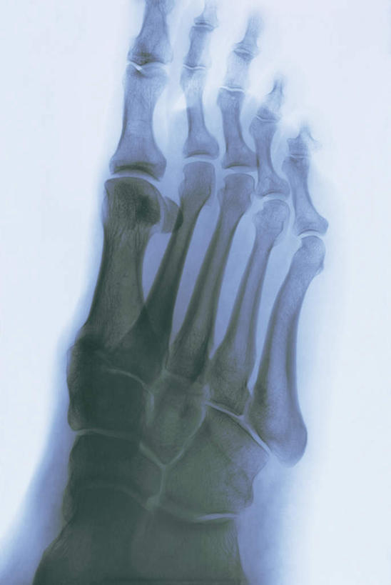 脚,脚趾,骨骼,脚背,踝,无人,竖图,x光片,室内,特写,白天,白色背景,正面,静物,辐射,科学,医学,骨头,骨架,医疗,科学技术,x射线,x光,脚底,彩图,电磁波,电磁辐射