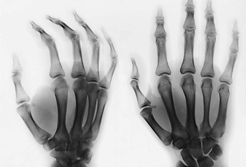 骨骼,无人,横图,x光片,室内,特写,白天,白色背景,正面,静物,辐射,科学,医学,骨头,两个,骨架,医疗,科学技术,x射线,x光,尺骨,肱骨,桡骨,腕骨,掌骨,指骨,彩图,电磁波,电磁辐射