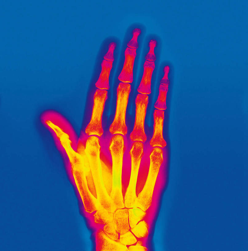 骨骼,无人,竖图,彩色,x光片,室内,特写,白天,正面,静物,蓝色背景,辐射,科学,医学,骨头,骨架,医疗,科学技术,x射线,x光,尺骨,肱骨,桡骨,腕骨,掌骨,指骨,彩图,电磁波,电磁辐射