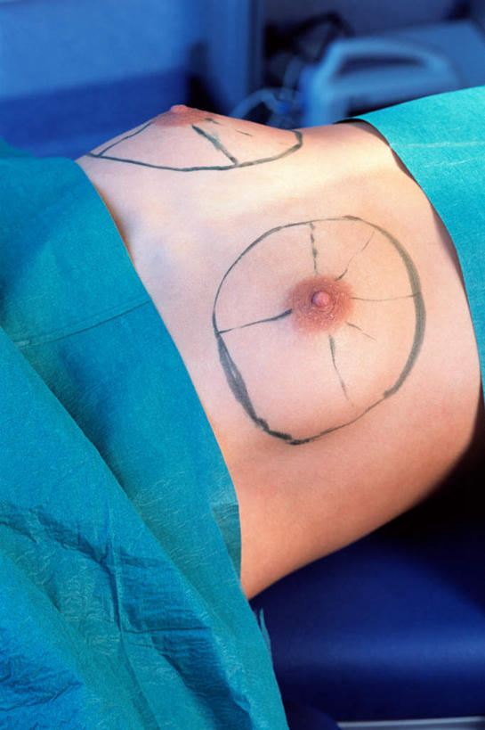 西方人,乳房,一个人,医院,躺,竖图,俯视,室内,特写,白天,绘画,床,欧洲,欧洲人,仅一个年轻女性,仅一个女性,仅一个人,阴影,反射,圆形,影子,床单,被子,裸露,单人床,手术室,被单,裸,整容,医疗机构,隆胸,卧着,年轻女性,女人,女性,白种人,躺着,卧,半身,彩图,高角度拍摄,病院,诊所