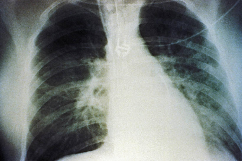 内脏,肺,动脉,静脉,无人,横图,黑白,x光片,辐射,科学,医学,生病,人体,摄影,医疗,生物学,人体器官,胸腔,科学技术,x射线,器官,x光,自然科学,博物学,生物科学,肺部,肺脏,电磁波,电磁辐射