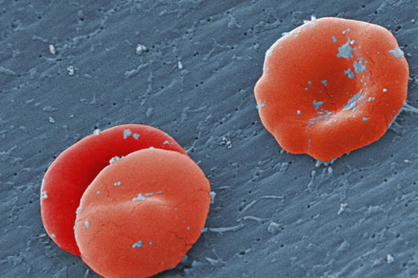 无人,横图,科学,红色,蓝色,生病,血液,摄影,疾病,红细胞,彩图,贫血,常染色体显性遗传病,镰状细胞贫血,血红蛋白病,遗传病,电子显微镜