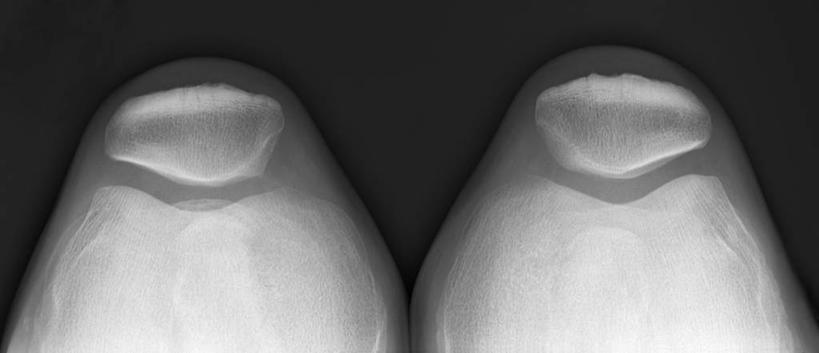 腿,一个人,横图,全景,黑白,x光片,特写,大腿,辐射,科学,医学,骨头,摄影,部分,医疗,科学技术,x射线,x光,股骨,四肢,人体结构,电磁波,电磁辐射