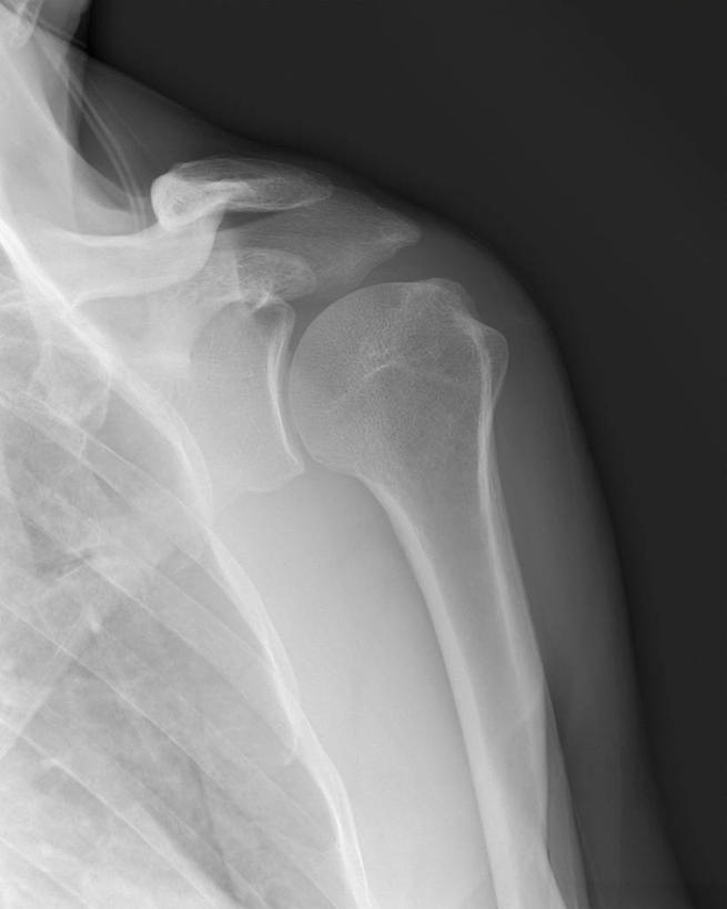 肩,肩胛骨,关节,一个人,竖图,黑白,x光片,特写,辐射,科学,医学,骨头,摄影,部分,医疗,科学技术,x射线,x光,肱骨,人体结构,电磁波,电磁辐射