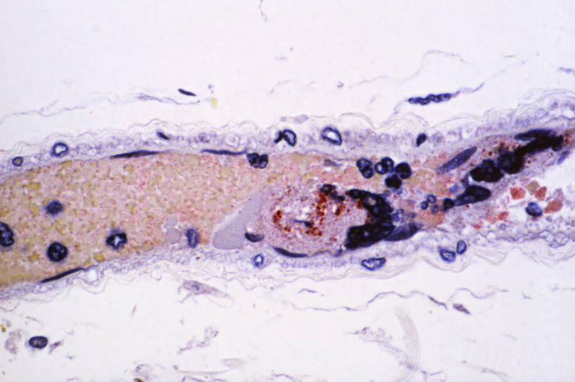 无人,横图,细菌,生病,摄影,痛苦,改变,巨人,脑炎,彩图