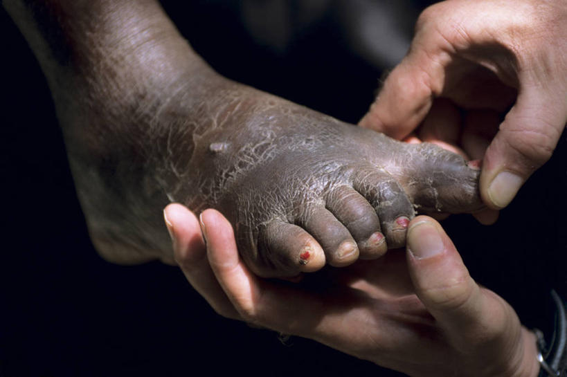 西方人,手,两个人,横图,特写,白天,蚊子,欧洲,海地,欧洲人,细菌,生病,摄影,皮肤,部分,西印度群岛,干的,足,丑陋,淋巴系统,象皮病,伊斯帕尼奥拉岛,白种人,彩图,海地人