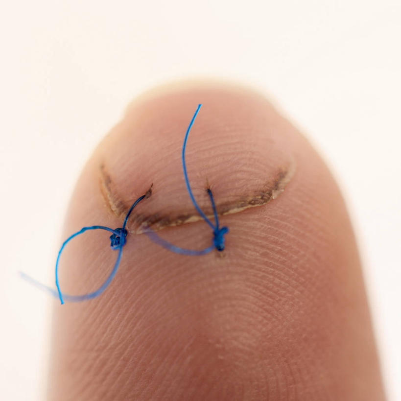 方图,白天,医疗用品,生病,摄影,疾病,伤口,受伤,损伤,彩图,挫伤,缝线