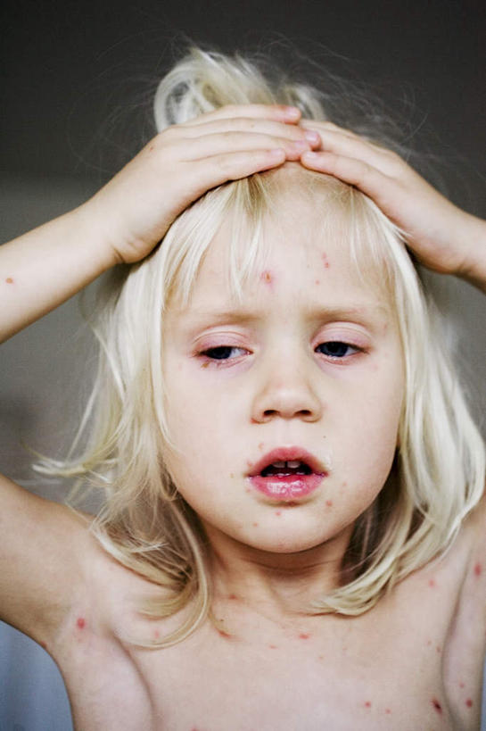 西方人,儿童,头发,一个人,竖图,室内,白天,正面,微生物,欧洲,欧洲人,仅一个女性,仅一个人,抱头,阴影,沮丧,光线,医学,影子,斑点,裸露,小孩,仅一个小孩,生病,金色,生物,赤裸,医疗,病毒,生物学,裸,懊丧,丧气,捧首,捧头,寄生,生命体,生物病毒,抱病,密密层层,密密麻麻,女孩,女人,女性,白种人,孩子,半身,彩图,女生