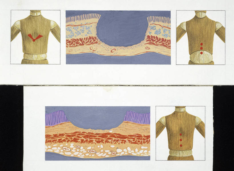 无人,横图,插画,正面,数码,科技,阴影,网络,高光,几何,计算机图形,合成,图画,画,生病,摄影,部分,电脑合成图,数码合成图,合成图,漫画,写实,具体,具象,溃疡,人体结构,彩图,胃溃疡,十二指肠球部溃疡