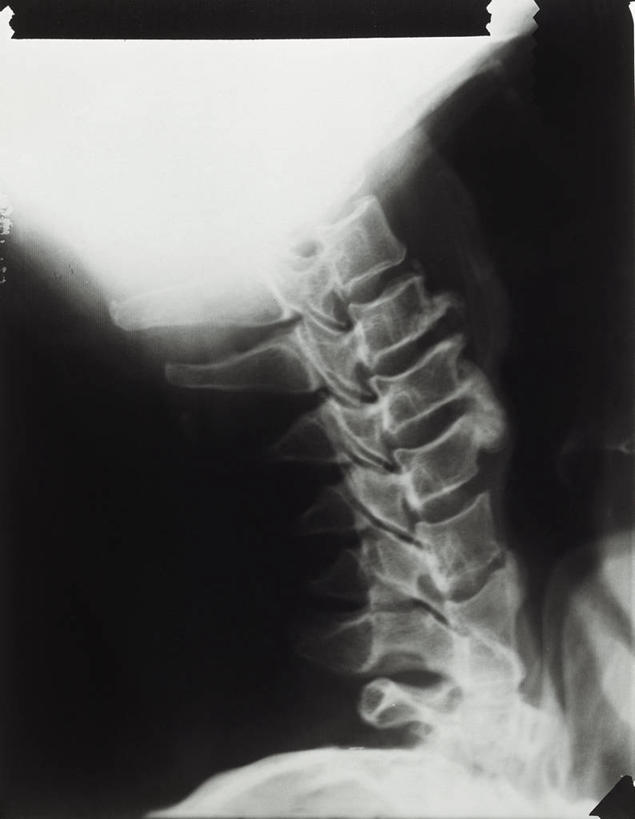 骨骼,脊椎,无人,竖图,插画,x光片,数码,科技,阴影,辐射,科学,网络,医学,高光,几何,计算机图形,合成,图画,画,人体,摄影,电脑合成图,数码合成图,医疗,科学技术,x射线,合成图,x光,漫画,写实,具体,具象,颈椎,关节炎,人体结构,畸形,脊柱,彩图,电磁波,电磁辐射,骨关节炎