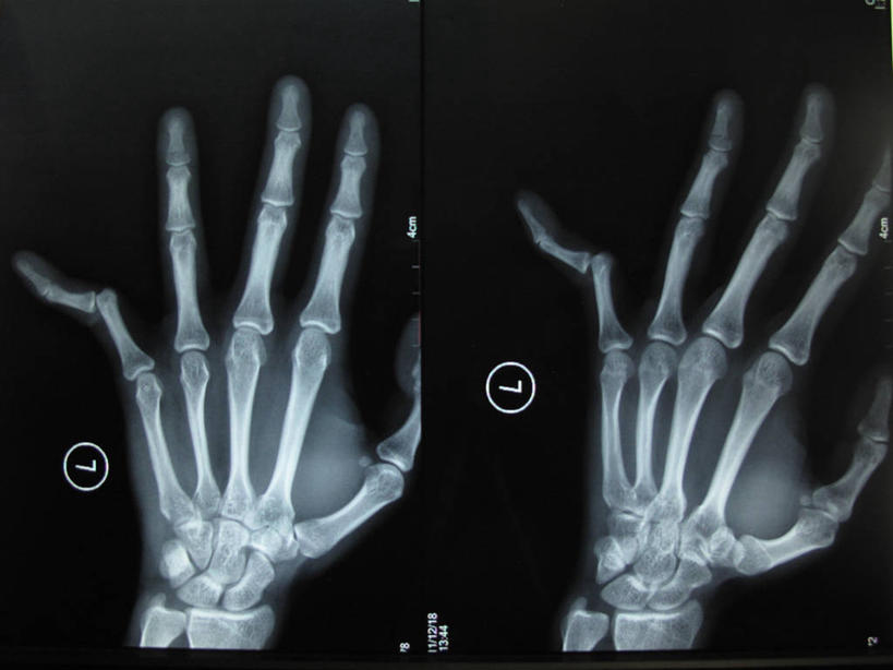 手,骨骼,无人,横图,x光片,特写,上海,辐射,科学,医学,手指,人体,摄影,医疗,科学技术,x射线,x光,彩图,电磁波,电磁辐射