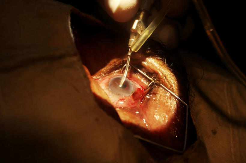 成年人,眼睛,虹膜,两个人,横图,室内,特写,安全,苏丹,瞳孔,光,防护,手套,手指,注射,眼部,摄影,保护,部分,透镜,验光师,手术,伤口,眼球,手术室,准确,照明设备,保险,医疗工具,保全,周全,安稳,安定,防护手套,平安,眼,彩图,白内障