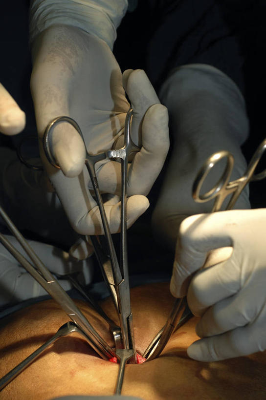 三个人,病人,竖图,室内,特写,苏丹,不锈钢,镊子,拿着,血液,摄影,部分,准确,外科医生,手术器械,腹膜,彩图