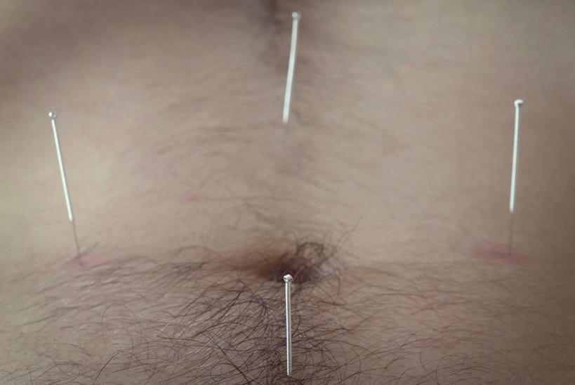 成年人,一个人,病人,横图,特写,仅一个男性,仅一个人,英格兰,仅一个年轻男性,摄影,皮肤,部分,针灸,针灸针,替代疗法,男人,男性,年轻男性,年轻人,彩图,全画面,全框架,全帧,全画幅