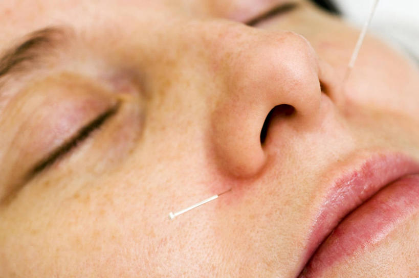 成年人,一个人,病人,横图,室内,特写,白天,化妆,美容,仅一个女性,护肤,英格兰,保养,享受,休闲,棉签,放松,保健,摄影,皮肤,部分,准确,针灸,养颜,针灸针,替代疗法,闭着眼睛,彩图,SPA美容